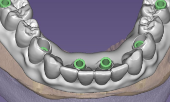 Zubní implantace pomocí chirurgické šablony